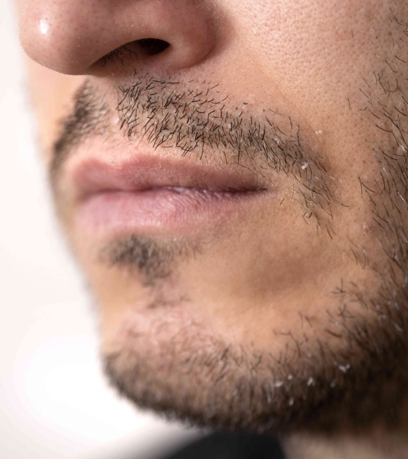 close-up-man-with-dandruff-issues_optimized