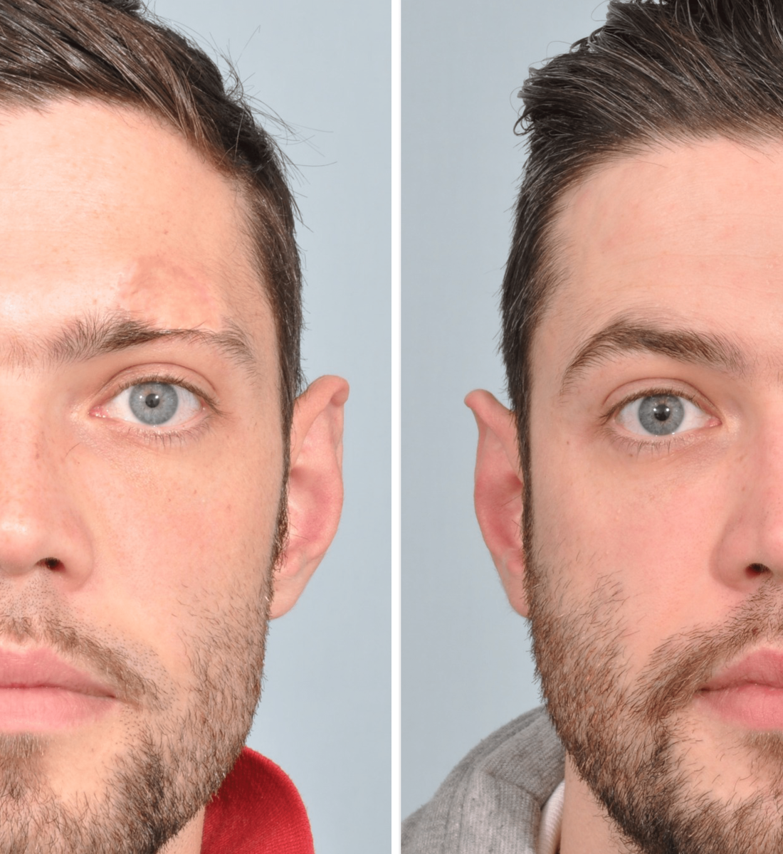 Kaş Ekimi Öncesi / Sonrası 1