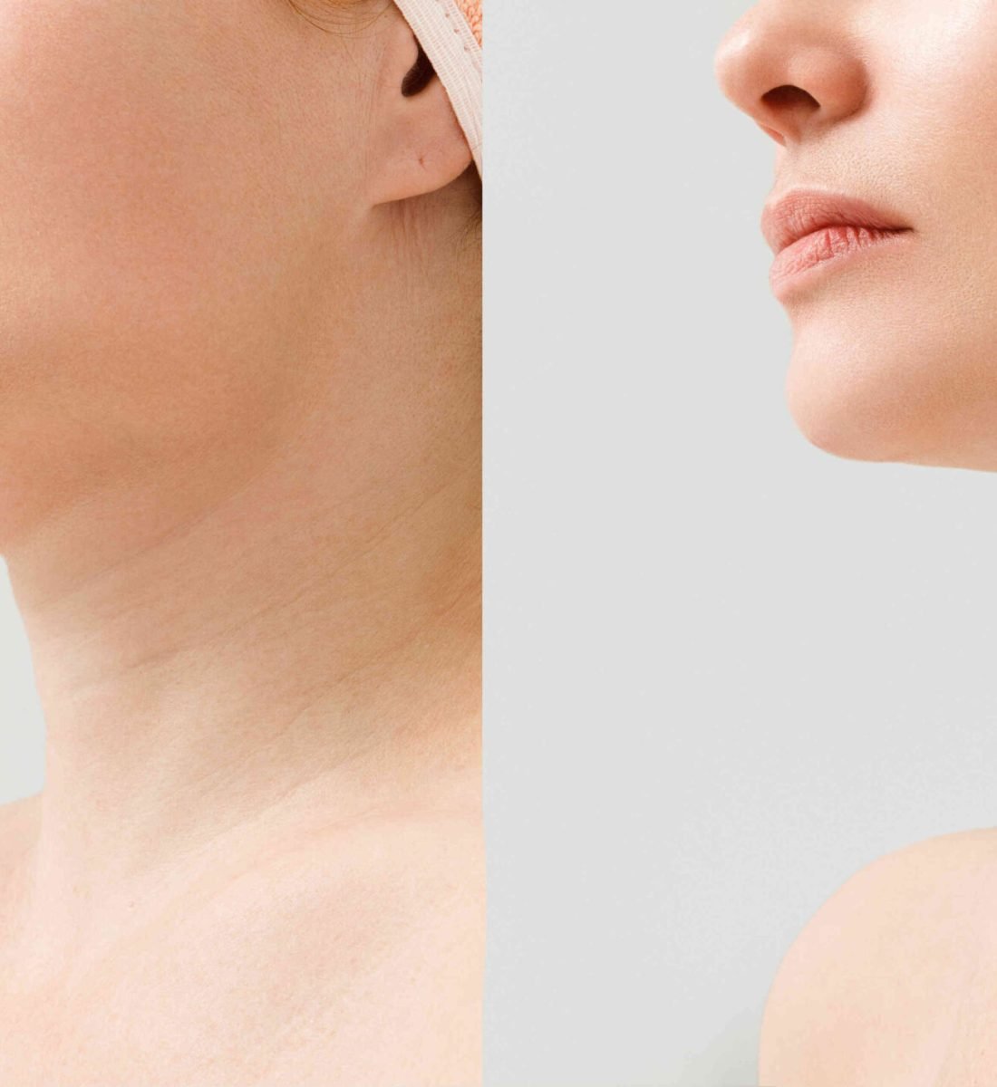 Boyun Germe Öncesi / Sonrası 1