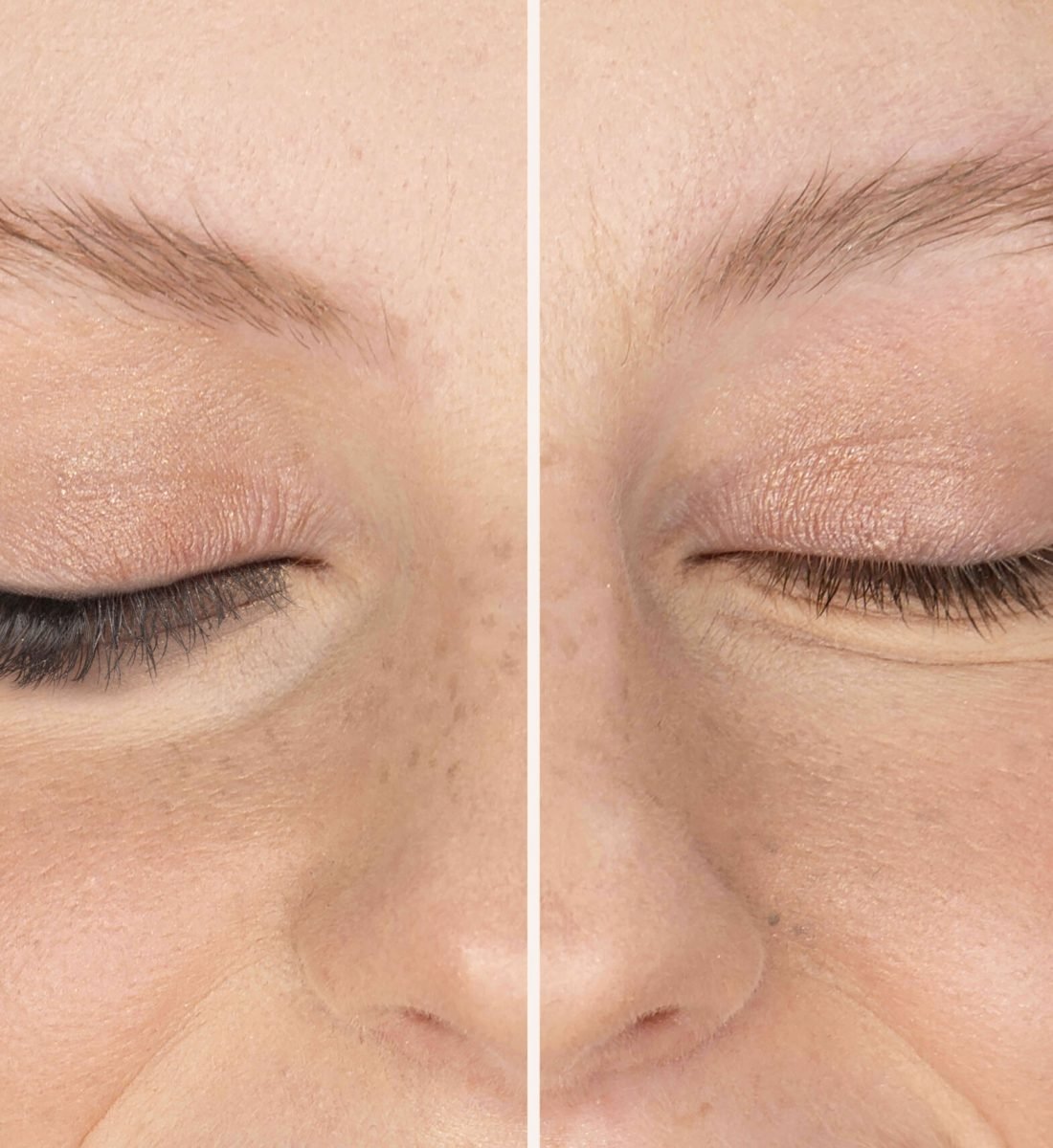 Göz Kapağı Estetiği Öncesi / Sonrası 1