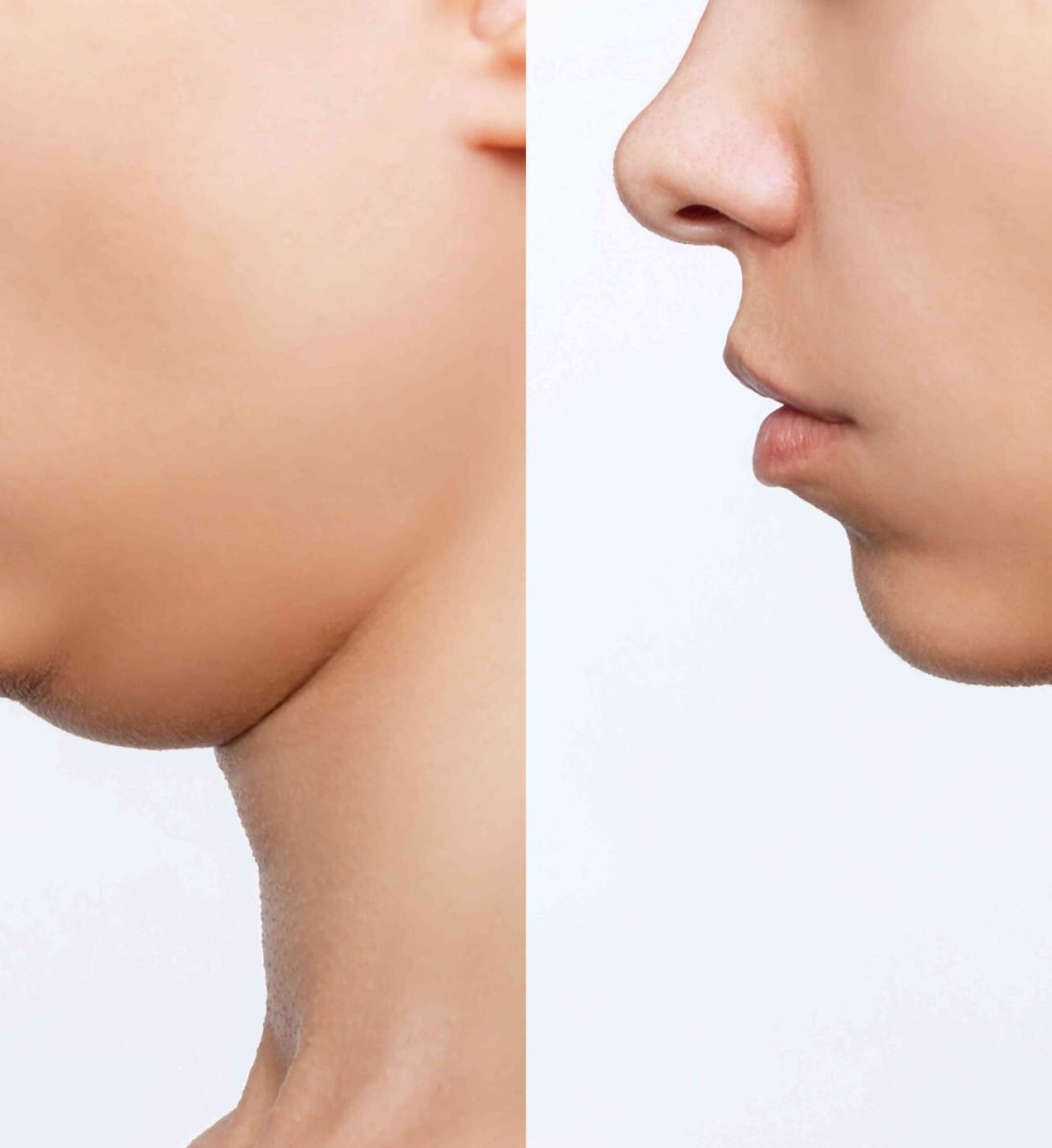 Boyun Germe Öncesi / Sonrası 4