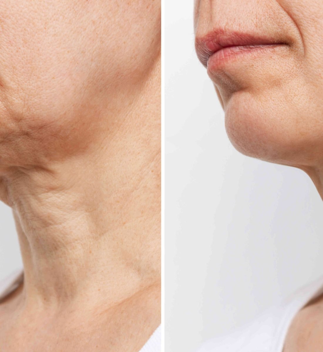 Boyun Germe Öncesi / Sonrası 3