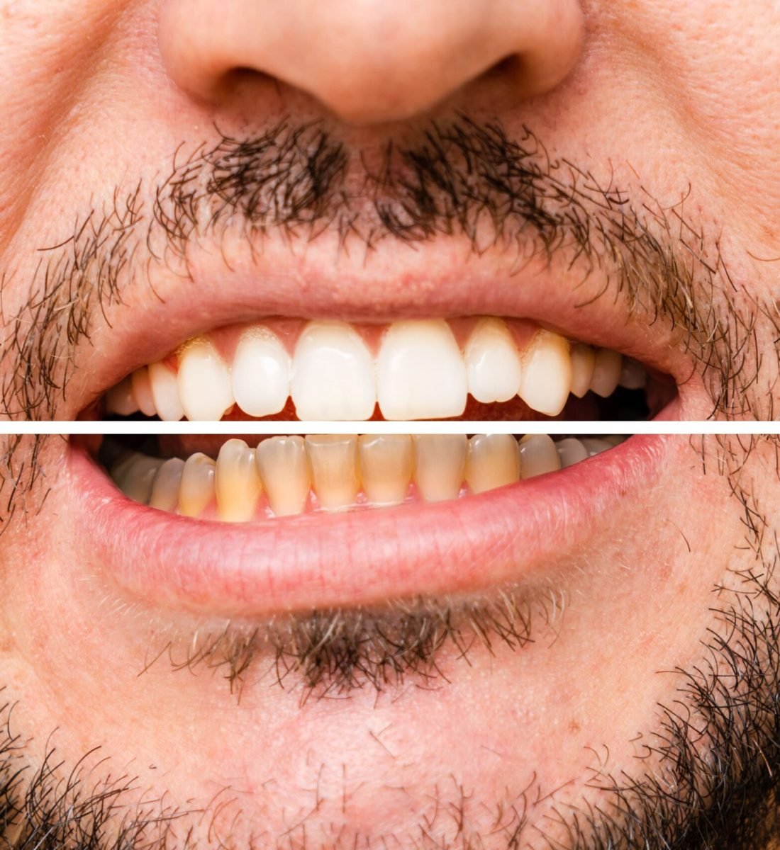 Diş Estetiği Öncesi / Sonrası 6