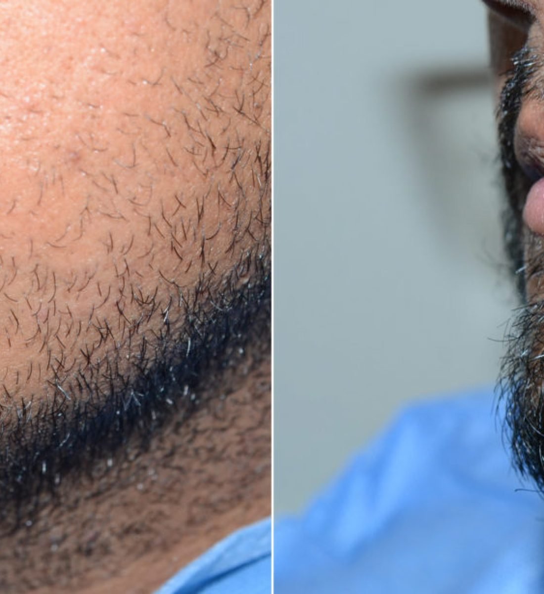 Sakal Ekimi Öncesi / Sonrası 2