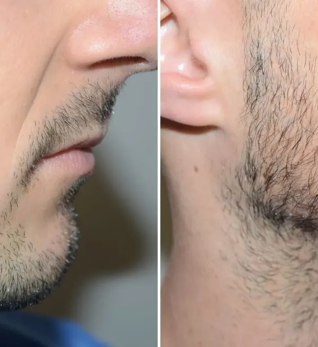 Sakal Ekimi Öncesi / Sonrası 3