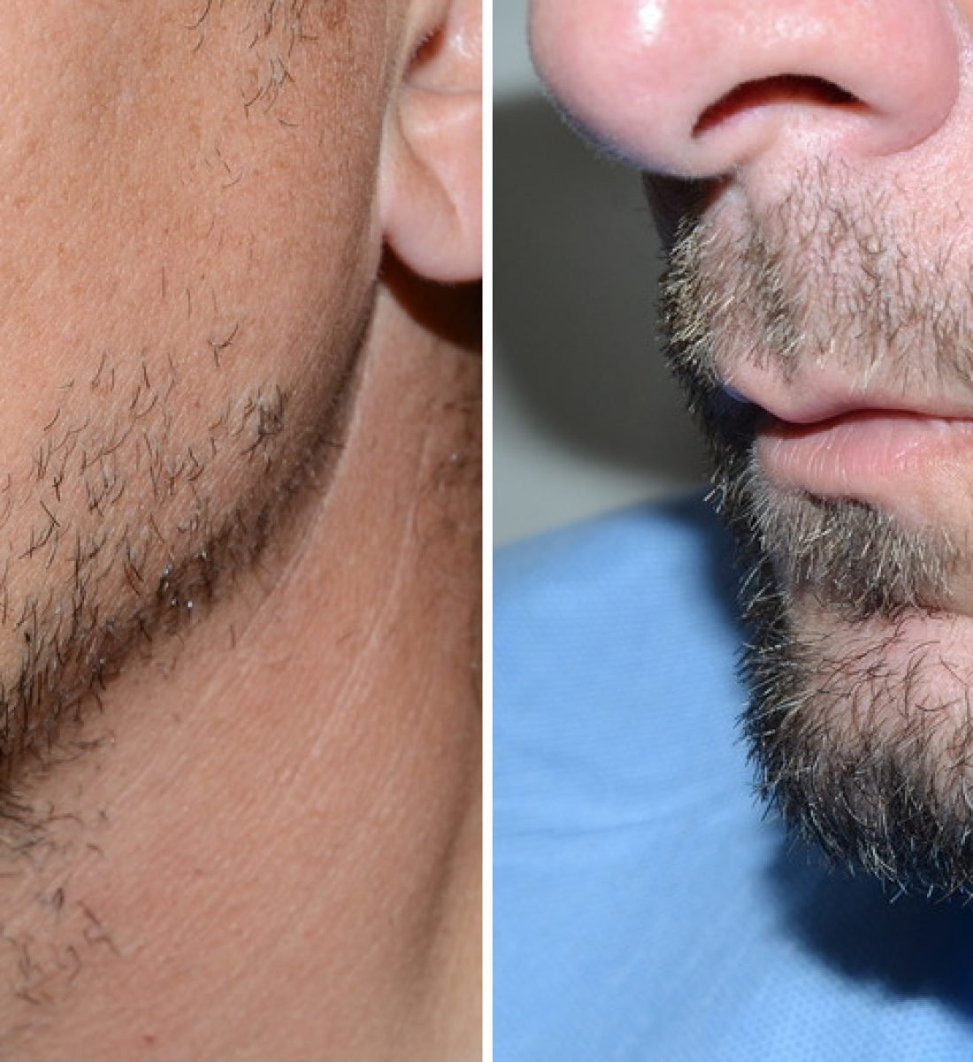 Sakal Ekimi Öncesi / Sonrası 4