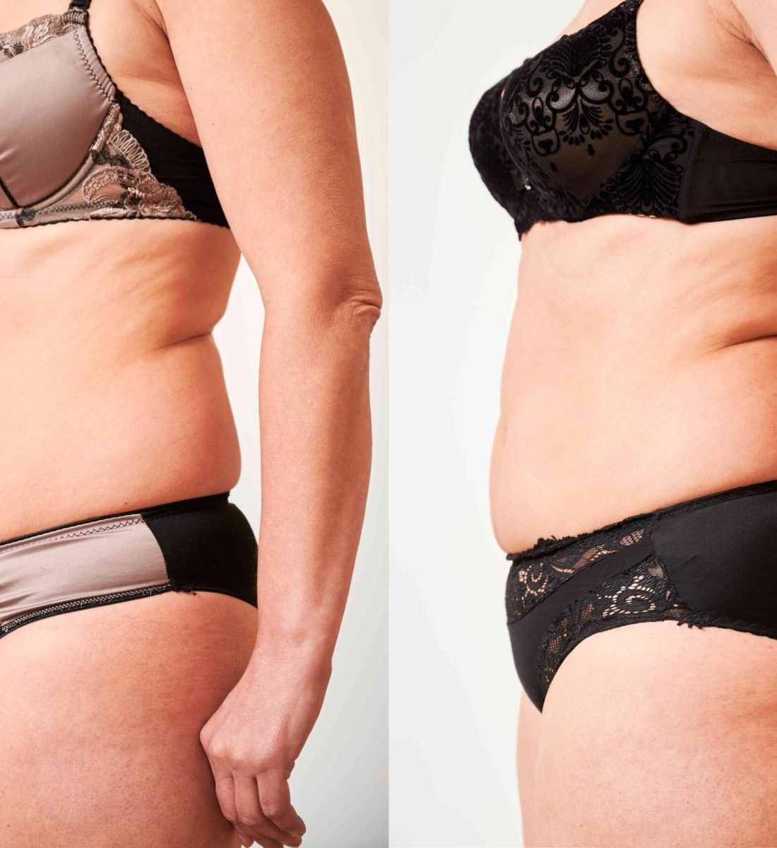 Obezite Cerrahisi Öncesi / Sonrası 3