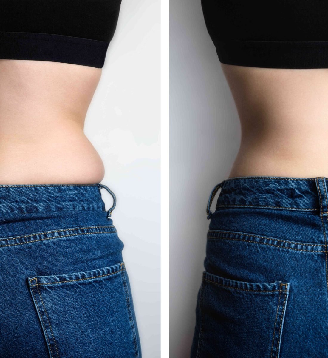 Obezite Cerrahisi Öncesi / Sonrası 4